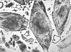 M, | crystalline inclusions in plasmocyte